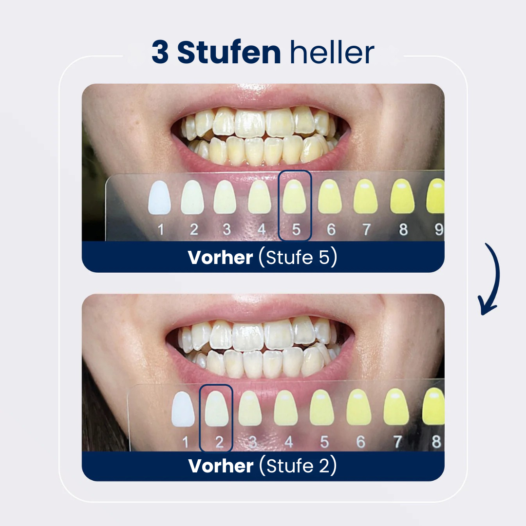Smile Whitening System