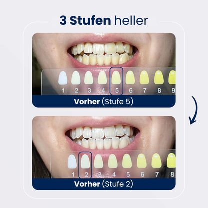 Smile Whitening System