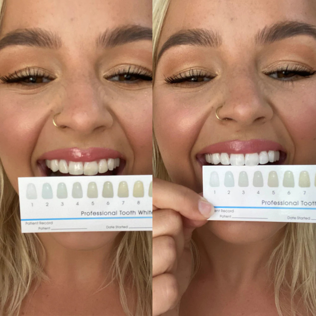 Smile Whitening System