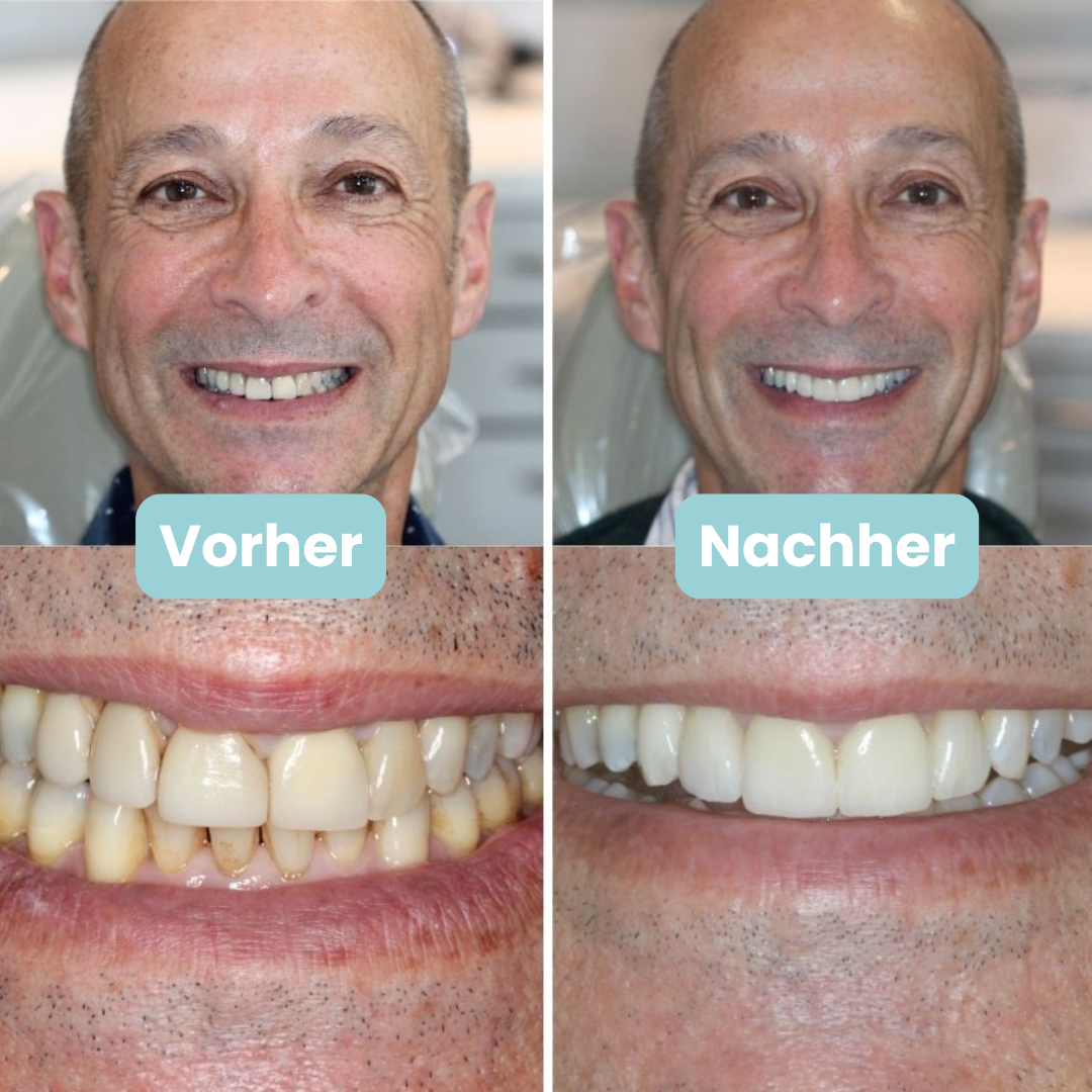 Oralux - U Shape Zahnbürste